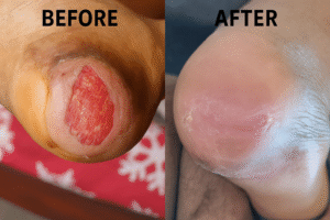 Advanced wound healing for diabetic foot in Bangalore