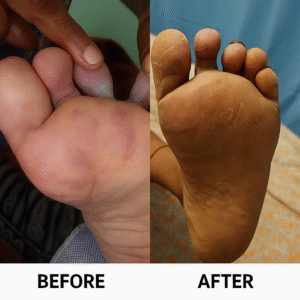 Before and after diabetic foot ulcer treatment in Bangalore